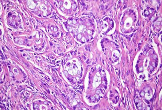 Well-differentiated Mucinous Carcinoma with Pseudomyxoma Ovarii Teratoma-associated Invasive