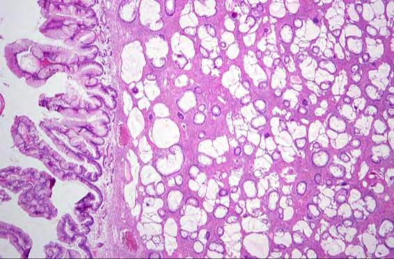 Ring Cell Carcinoma Mucinous Tumors Associated With Teratomas H&E + IHC: Many resemble lower