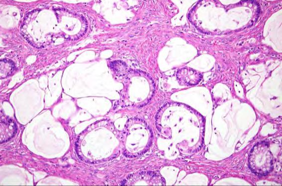 not just tumor-to-tumor metastases: Clinicopathologic features c/w primary ovarian origin