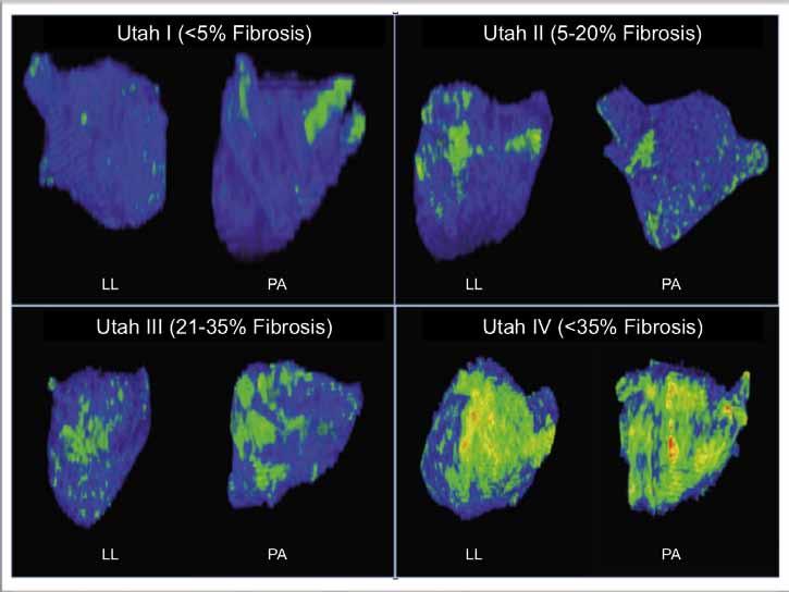 MRI of the left atrium: predicting clinical outcomes in patients with atrial fibrillation Review Utah I (<5% fibrosis) Utah II (5 20% fibrosis) Utah III (21 35% fibrosis) Utah IV (>35% fibrosis)