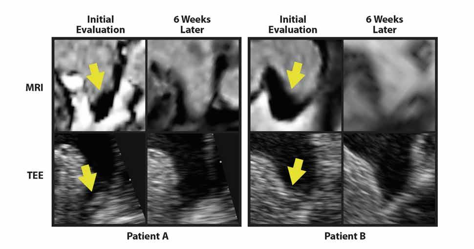 MRI of the left atrium: predicting clinical outcomes in patients with atrial fibrillation Review Initial evaluation 6 weeks later Initial evaluation 6 weeks later MRI TEE Patient A Patient B Figure 4.
