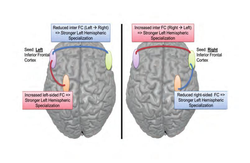 Clinical Neuroimaging Task activation with white matter track Right Motor Tract Sensory Tract Figure 6 Diffusion tractography showing the likely location of motor and sensory