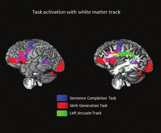Diffusion tractography was used to depict the likely location of the white matter tract called the arcuate (seen in green) connecting these two language regions.