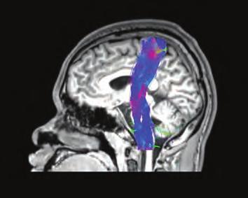 The pattern increased (red) and decreased (blue) shown for both seeds involving the left and right inferior frontal cortex applied to both left and right temporal lobe epilepsy