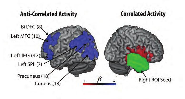 Figure 9 A resting state functional connectivity study showing the areas of anti or negatively correlated activity in the healthy right hemisphere connected to a right temporal lobe seed in a group