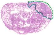 (c) Histopathology step-section with Gleason grade 3 + 3 area outlined (total tumour volume 1.923 cm 3 ). FIG. 3. The MRI model for predicting the probability of insignificant cancer in an individual patient.