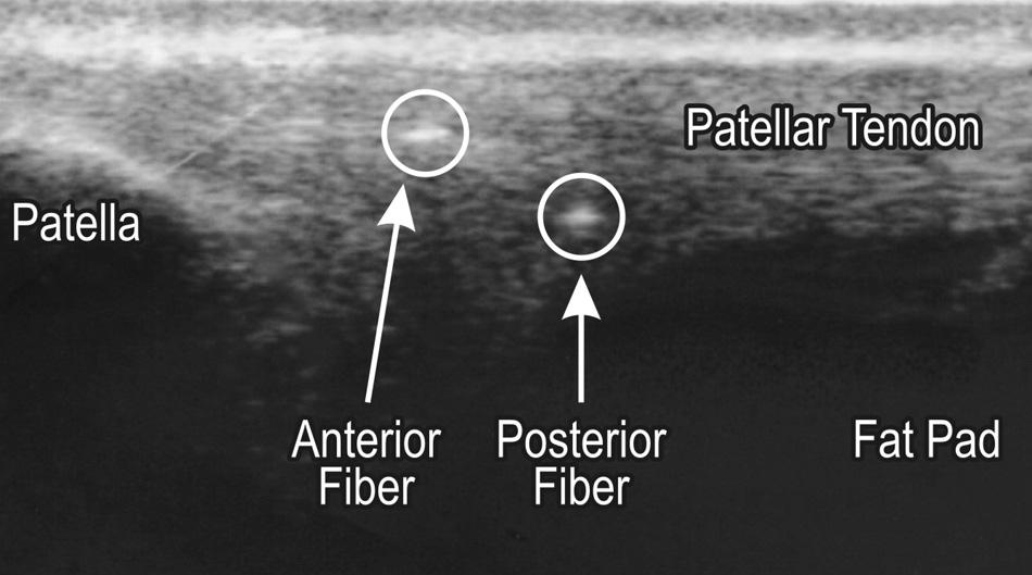 Vol. X, No. X, XXXX Characteristic Lesion of Patellar Tendinopathy 5 Figure 3. Ultrasound: sagittal view showing the position of the 2 optic fibers in the patellar tendon.