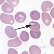 Babesiosis Babesia microti and other Babesia species LABS SIGNS/SYMPTOMS INCUBATION PERIOD: 1 9+ weeks SIGNS AND SYMPTOMS Fever, chills, sweats Malaise, fatigue Myalgia, arthralgia, headache