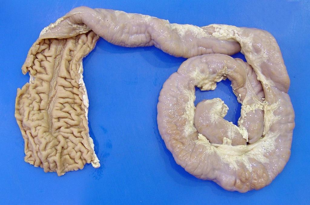 the ileum with pronounced folding of the
