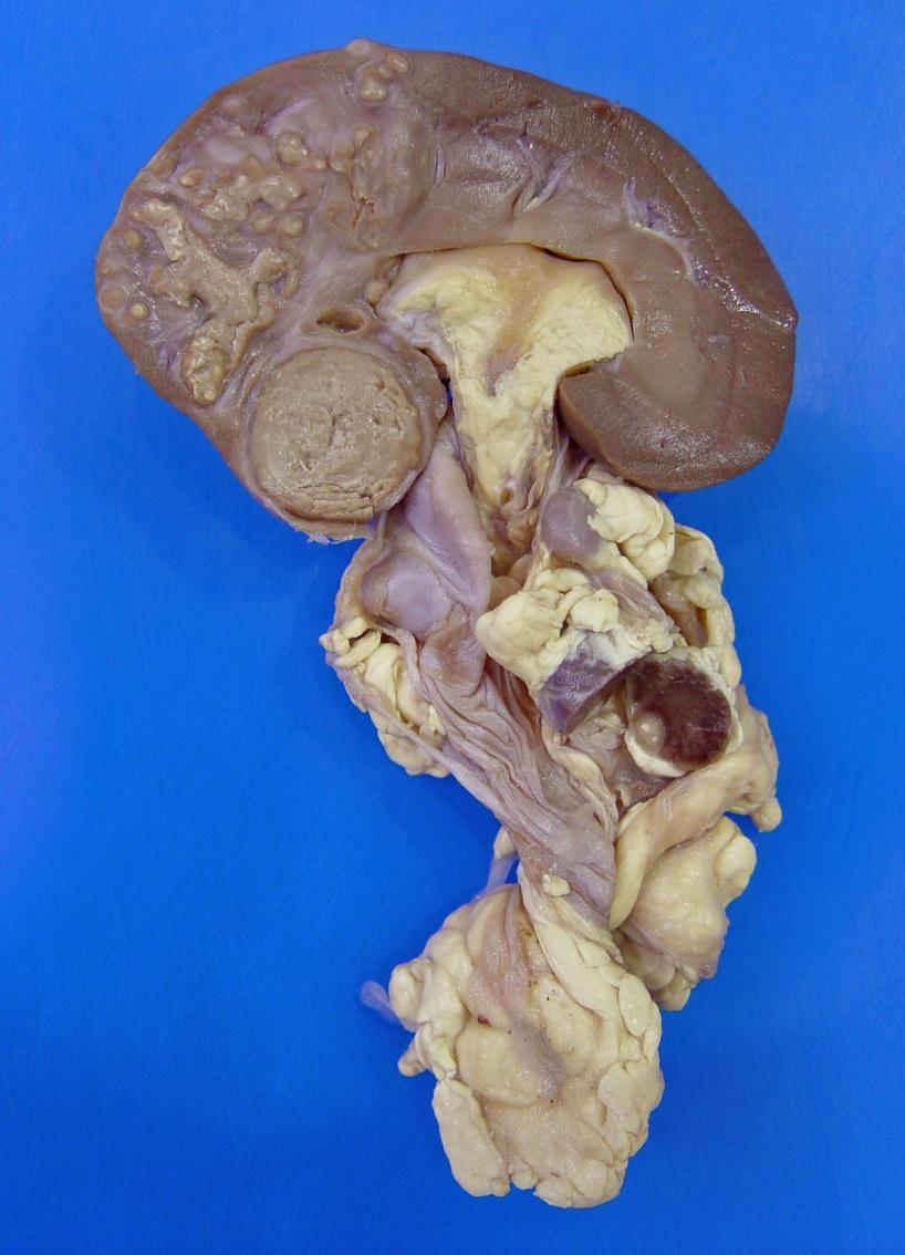 Inflammation Case 1 Kidney from a sheep with a