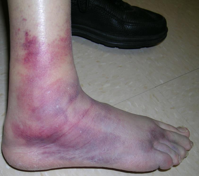 History Evaluation Swelling or bruising