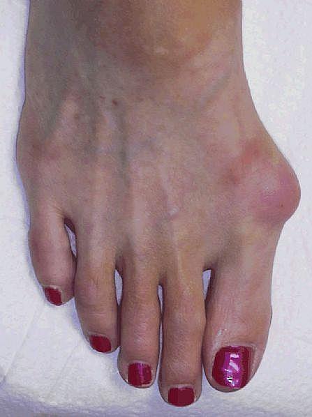 Physical Examination Observation (Cont ) Bunion