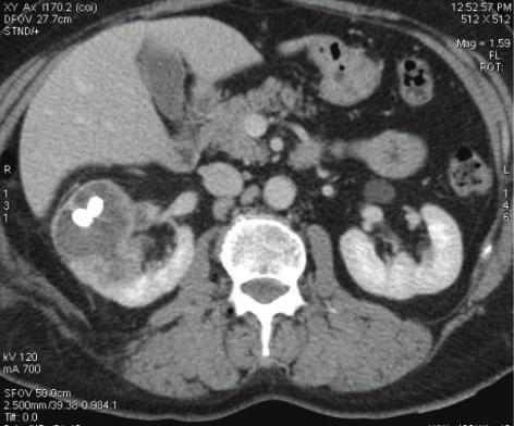 2 Case Reports in Urology (c) Figure 1: Preoperative CT scan.
