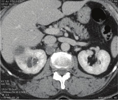 Microscopic examination of the tumor submitted in toto revealed a moderately differentiated SCC with marked keratinization. Renal sinus fat and renal sinus vein invasion were identified.