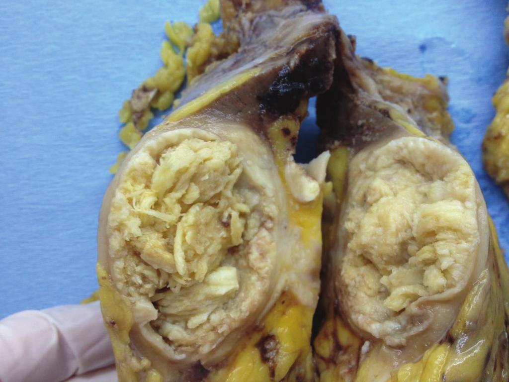 Extensive squamous metaplasia of the urothelium in the renal pelvis was observed. Lymph node metastasis was found in two lateral caval lymph nodes, the largest measuring 3.