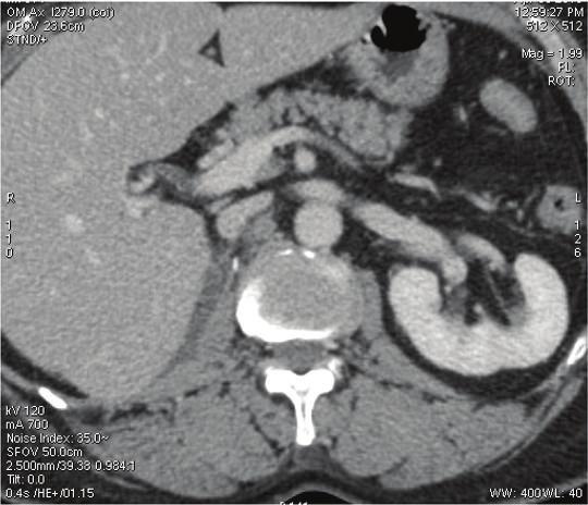 Case Reports in Urology 3 Figure 3: Postoperative CT scan.