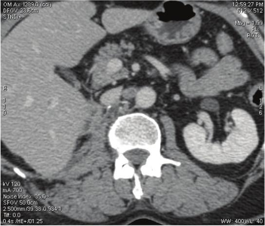 Figure 4: CT scan performed after 4 cycles of chemotherapy. Axial nonenhanced CT scan showing increase in size of the interaortocaval lymph node now measuring 2.