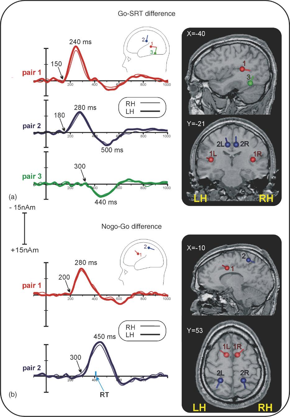 F. Di Russo et al. / Neuroscience Letters 408 (2006) 113 118 117 Fig. 3. Source analysis of the ERPs obtained in the Go minus SRT and in the No-go minus Go differences.