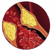 complications of atherosclerosis