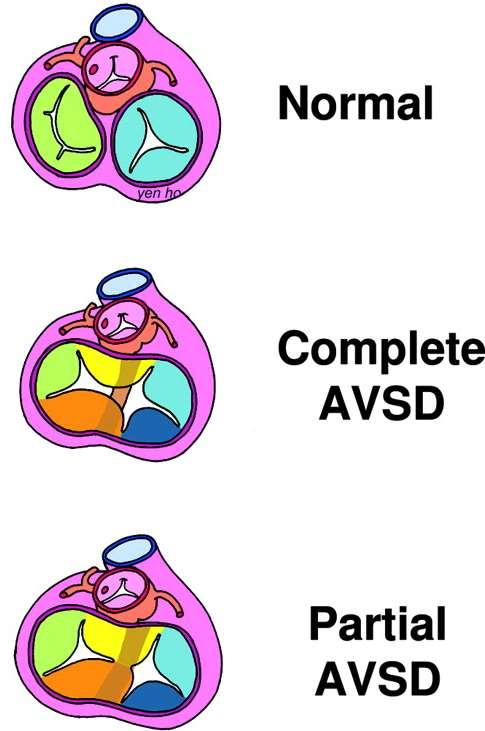 AVSDs Prevalence 2,9-7,4% 30% in Down syndrome Common ovoid shaped AV junction Five leaflet common AV valve Types