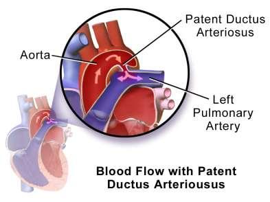 2,4% of CHDs PDA Vessel distal to the left subclavian artery Shunting from the aorta to the