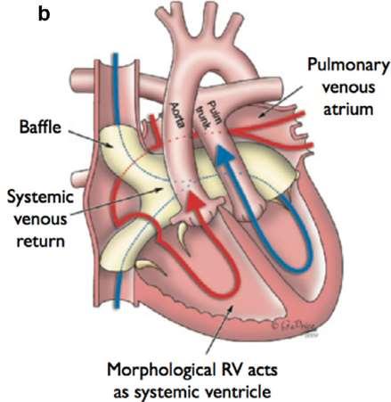 TGA- Atrial switch RV the systemic ventricle Mustard/Senning operation: Redirect