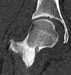 Osteoid Osteoma Radiolucent nidus Central calcification