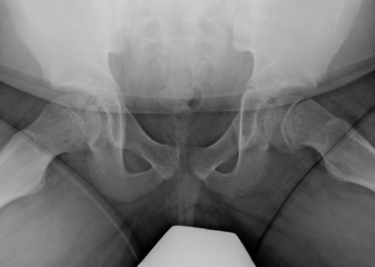 Slipped Capital Femoral Epiphysis THE Don t Miss diagnosis!