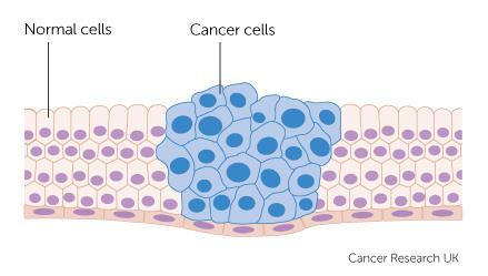 Breast Cancer Cancer begin in the in the DNA of breast cells Usually it is a damaged cell that has mutated and replicated It happens because of a number of factors including genetic, environmental,