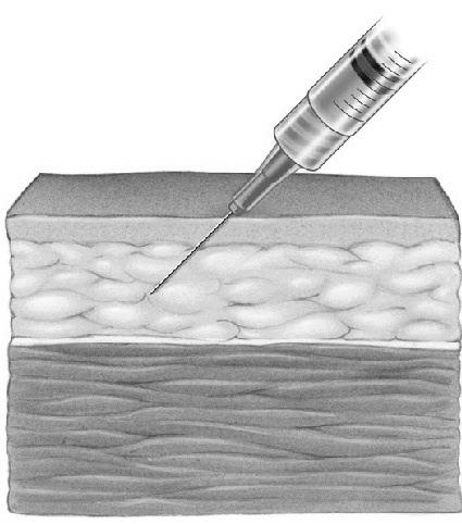 Right Needle Length and Technique for Subcutaneous (subcut) Injections Needle size: 23-25 gauge, 5/8 45 Angle Dermis Fatty tissue (SubQ ( SubQ) Muscle tissue Right Site for Subcutaneous