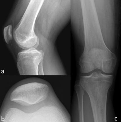 FIGURES Figure 1: 20 year old man with intra-articular osteoid osteoma.