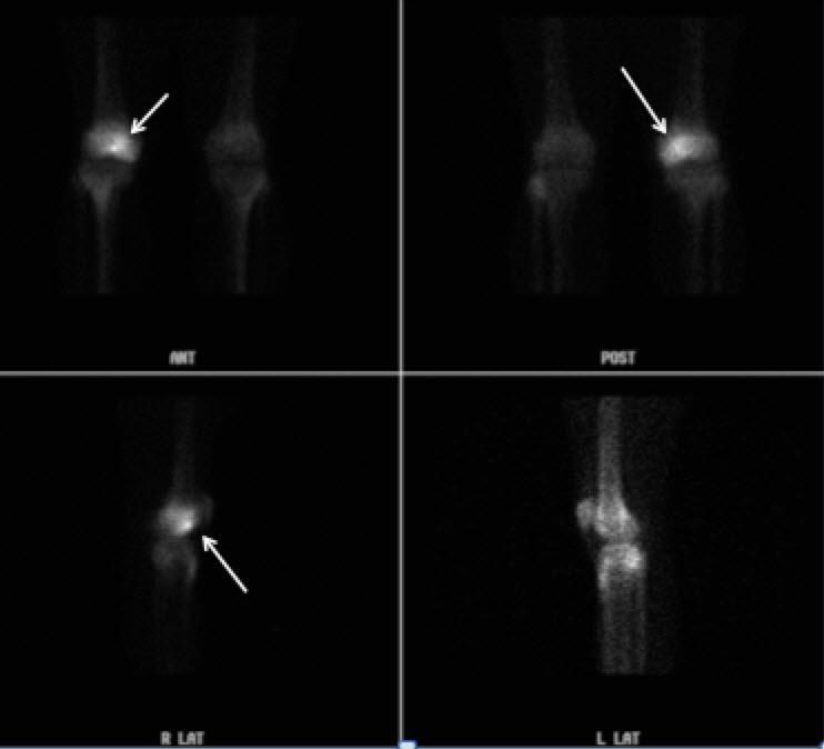Figure 3: 20 year old man with intra-articular osteoid osteoma. Findings: Radiotracer uptake is depicted at the distal femur (arrows) at the site of the lesion.
