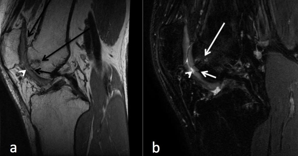 Figure 6: 20 year old man with intra-articular osteoid osteoma approximately six months following excision and osteochondral autograft transplant.
