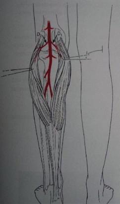 Normal function of the gastrocnemius muscle is plantar flexion of the foot, either or both heads of the gastrocnemius are expandable if the solius muscle is kept intact.