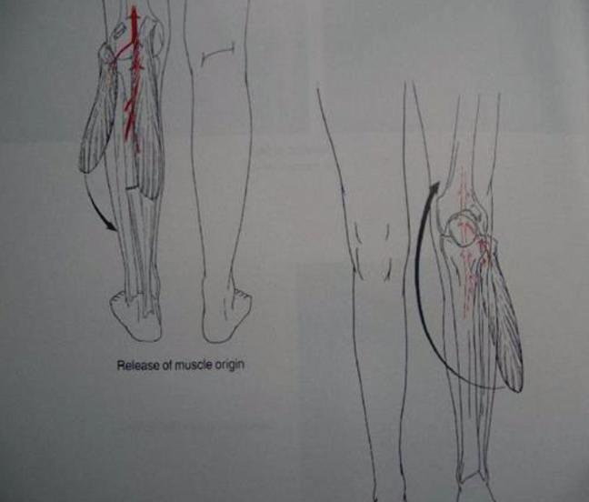 The estimated the location of the 6 origin of the sural artery from the popliteal artery to lie within 1 to 55 mm above the distal femur line.