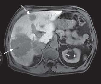 Liver metastases approached by combined