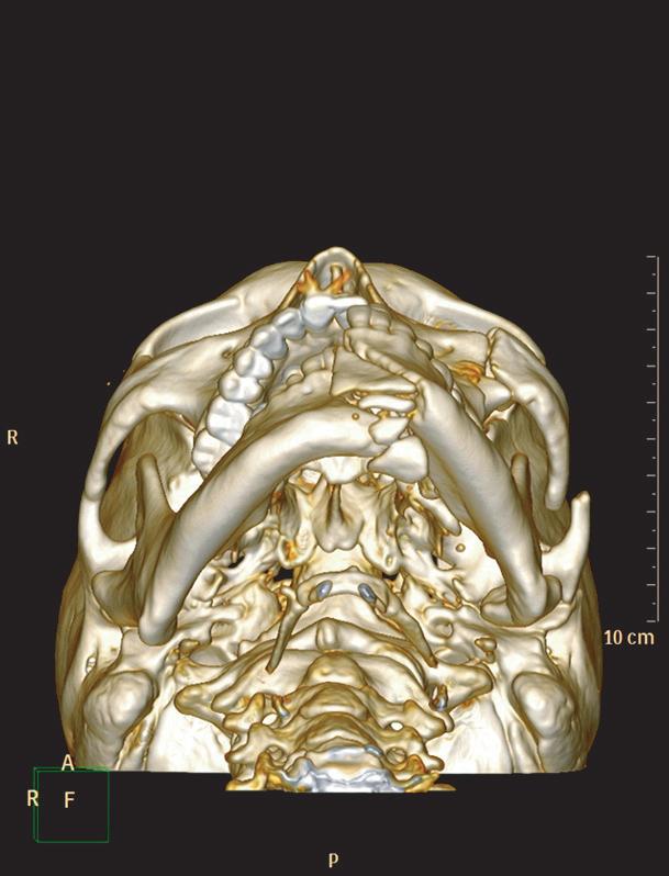 J Korean Assoc Oral Maxillofac Surg ;40:91-95 Board (CDMDIRB-1325-146). 1.