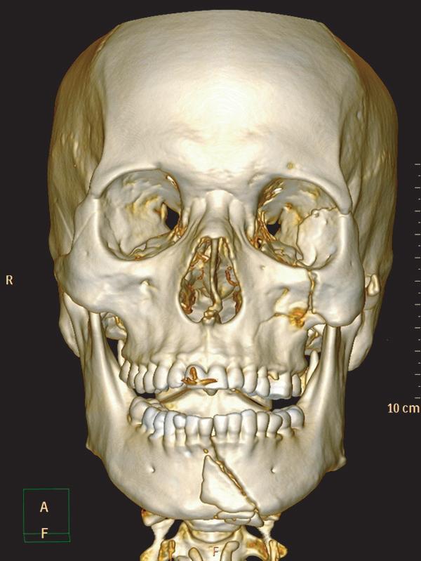 Based on the clinical and radiological examination results, the patient was diagnosed with fractures in both lateral orbital walls and in the left lower and interior orbital walls, a