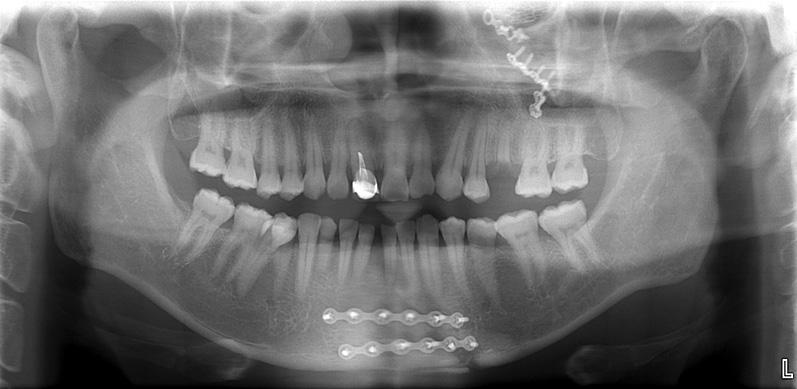 1) In Department of Otolaryngology, open reduction was performed for internal fixation using a metal plate in the area of the left orbit and at the site of the mandibular symphysis; in this surgical