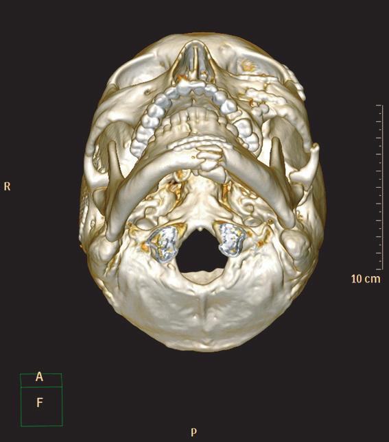 The treatment of malocclusion after open reduction of maxillofacial fracture Fig. 3. Computed tomography two months after surgery in Department of Otolaryngology. Fig. 4.