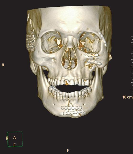 after open reduction of maxillofacial fracture: a report plates were removed under general anesthesia, and a LeFort I osteotomy was performed for maxillomandibular fixation to ensure