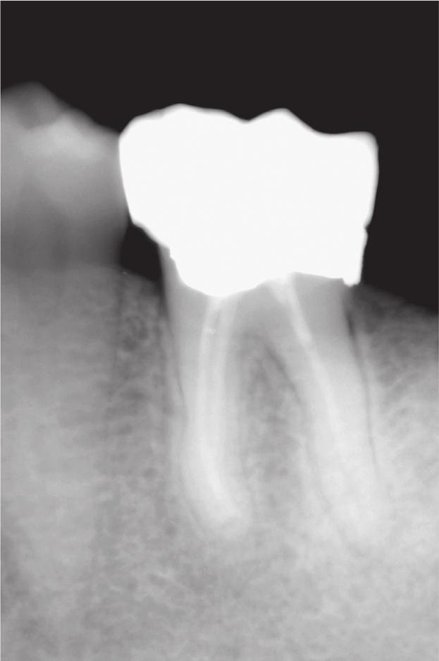 Untreated Apical Periodontitis D. Ricucci et al. Nov. 2005 Figure 1 Radiograph of tooth 36 taken in November 2005. Only thickening of the periodontal ligament space around the distal root was evident.
