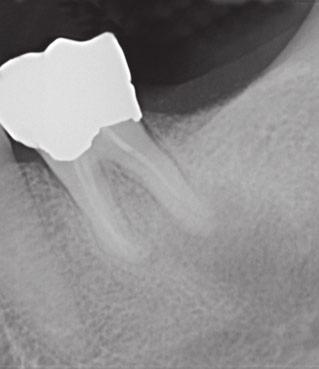 D. Ricucci et al. Untreated Apical Periodontitis (a) (b) (c) (d) June 2011 (e) (f) (g) (h) April 2015 Figure 2 (a) Radiograph of tooth 36 taken almost 6 years later.
