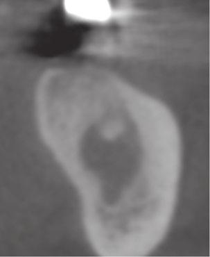 (b d) Cone-beam computed tomography (CBCT) scans, taken at the same time, confirmed the radiolucency.