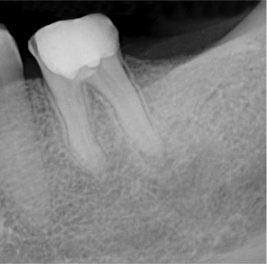 Untreated Apical Periodontitis D. Ricucci et al. (a) (b) (c) (d) Dec 2015 (e) Dec 2015 (f) Sep 2016 Figure 3 (a) After removal of the crown, the tooth was isolated.