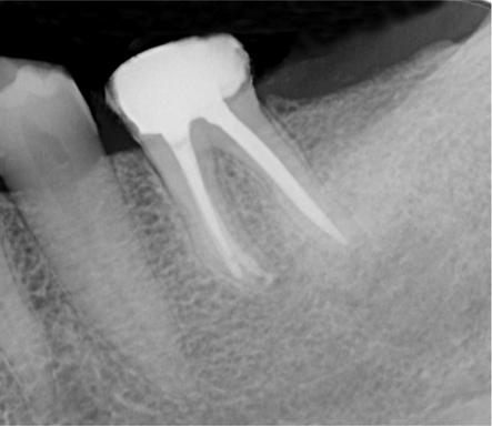 The radiolucent area had considerably reduced in size. (e) Postobturation radiograph.