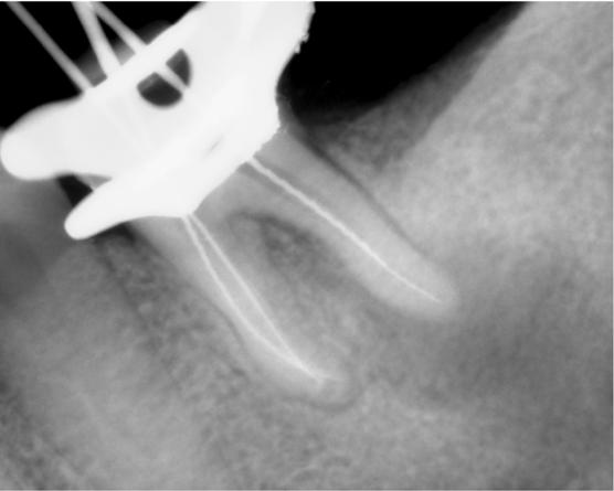 Surgery was avoided in this case due to the tooth s location and that the lesion had reached and involved the mandibular canal.
