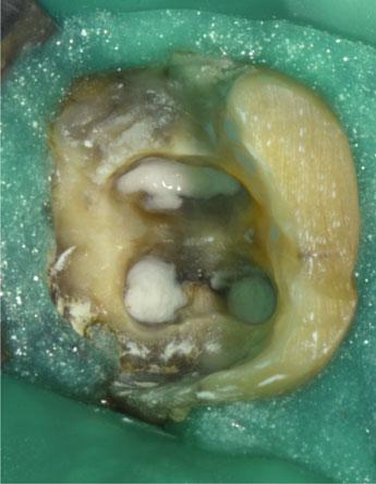Ultimately, the lesion completely healed 17 months after the endodontic retreatment was initiated.