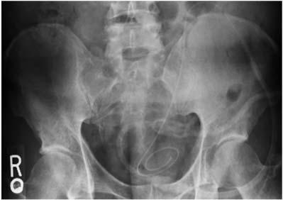 Compressed in Pelvis Slide 17 Sometimes a KUB x-ray can give a clue of the catheter tip being positioned too low in the pelvis with deformity of the coiled tip.