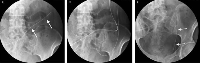 Part 1: Mechanical Fluoroscopic guidewire repositioning for catheter tip migration Fluoroscopic procedure for catheter manipulation Migration of straight-tip catheter out of the pelvis into upper